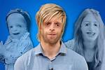 Celebrities with Treacher Collins Syndrome
