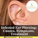 Claire's Ear Piercing Infection: Causes, Symptoms, and Treatment