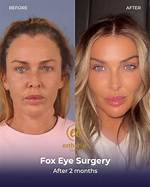 Discover the Secrets of Fox Eye Surgery: Before and After Revealed