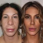 Her Stunning Transformation Through Plastic Surgery