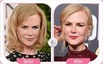 Plastic Surgery Denials: the Truth Behind Nicole Kidman's Transformation