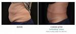 Results Gone Wrong: Cool Sculpting Before and After