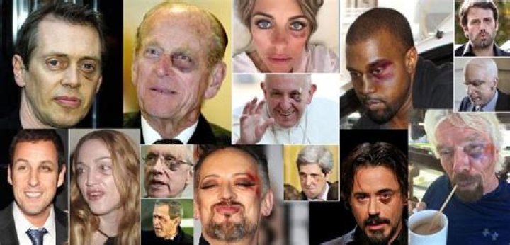 The Black Eye Club: Decoding the Conspiracy & Celebrity Black Eyes