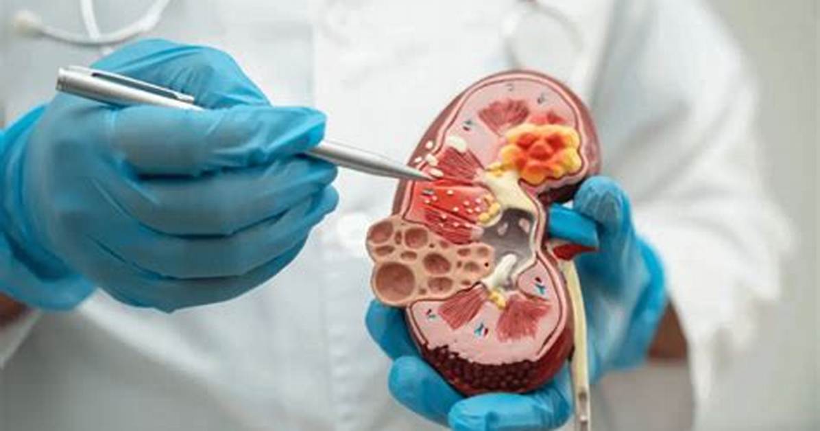 Ultimate Guide to Understanding Kidney Surgery Scarring