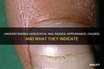 Understanding Horizontal Ridges on Fingernails: What Do They Indicate?