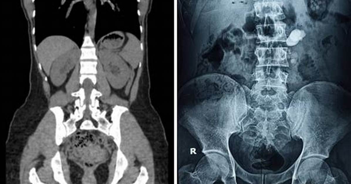 Understanding the Aftermath: Kidney Removal Scarring