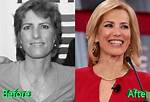 Unveiling Laura Ingraham's Plastic Surgery Journey: Insights and Revelations