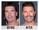 Unveiling Simon Cowell's Plastic Surgery Journey: a Transformation Tale