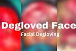 Unveiling the Horrors: Understanding the Degloved Face💀