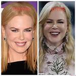 Unveiling the Truth Behind Nicole Kidman Filler: a Deep Dive