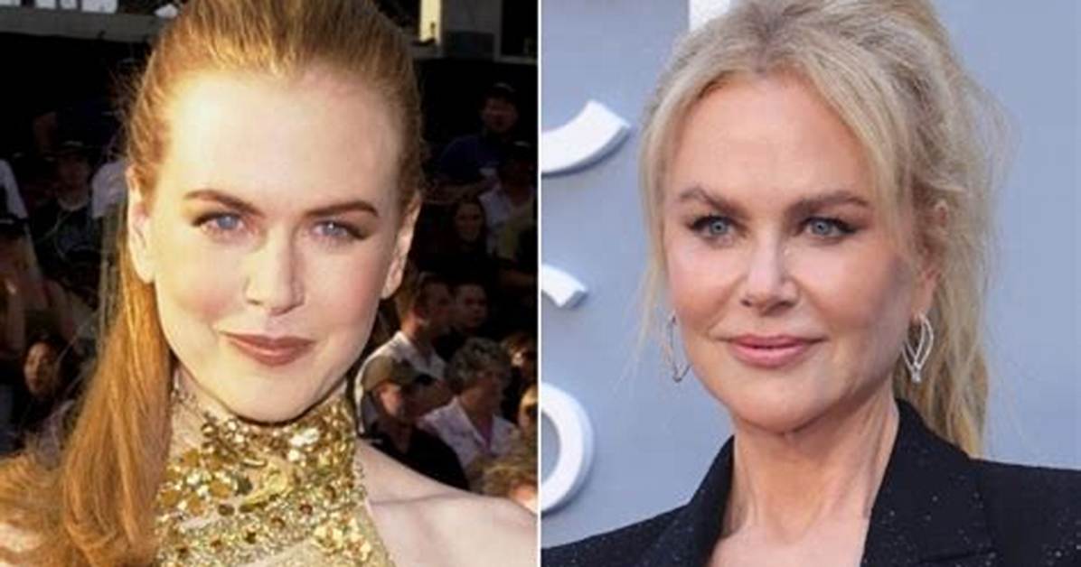 Unveiling the Truth: Did Nicole Kidman Get Botox?
